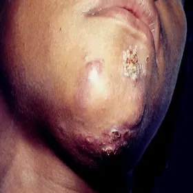 Sporotrychoza na twarzy