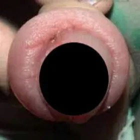 Spuchnięty napletek choroba załupek