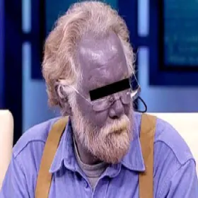 Srebrzyca, argyria 