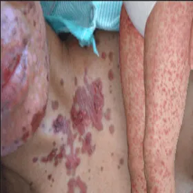 Stevens-Johnson syndrome 