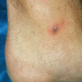 Stopa guzek rzeżączka choroba