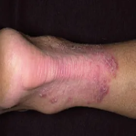 Stopa sportowca, grzybica nóg