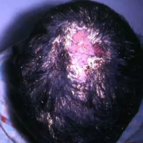 Strupień woszczynowy na skórze głowy