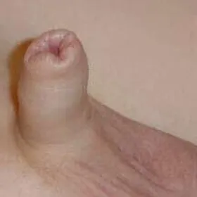 Stulejka u dzieci zdjęcie