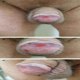 Sucha żołądź zapalenie plazmakomórkowe żołędzi Zoon 