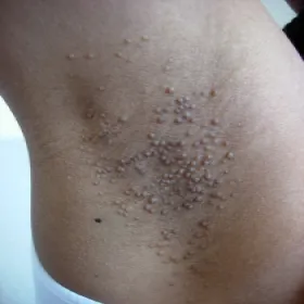 Swędzące zmiany skórne pod pachami choroba Foxa-Fordyce'a