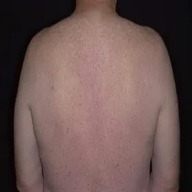 Swędząca wysypka na plecach choroba Grovera