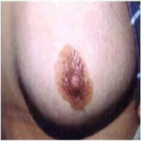 Swędzenie jednej brodawki