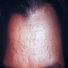 Syringoma na czole zdjęcie