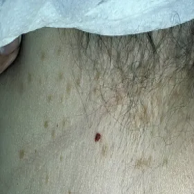 Syringoma okolic intymnych