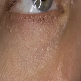 Syringoma to nowotwór łagodny skóry