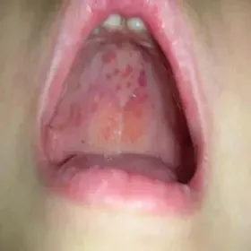 Szkarlatyna w jamie ustnej dziecka