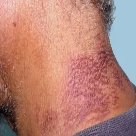 Szyja zmiany skórne pelagra