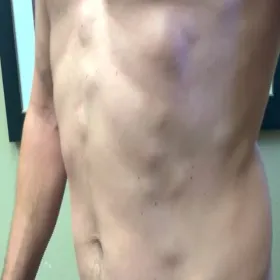 Tłuszczak na brzuchu choroba Dercuma