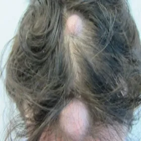 Tłuszczak na głowie choroba Dercuma