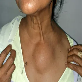 Tłuszczak na klatce piersiowej