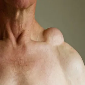 Tłuszczak na ramieniu