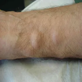 Tłuszczak zlokalizowany na ręce