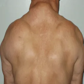 Tłuszczaki na plecach choroba Dercuma