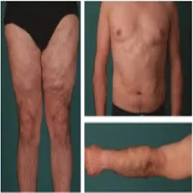 Tłuszczaki podskórne w chorobie Dercuma