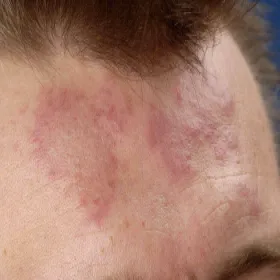 Toczeń rumieniowaty krążkowy na czole