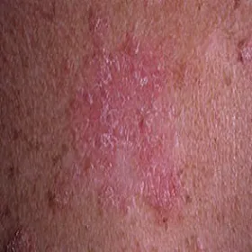 Toczeń rumieniowaty krążkowy plamy na skórze