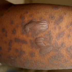 Toksyczna nekroliza naskórka zdjęcie