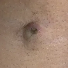 Torbiel osłonki włosa