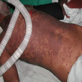 Toxic epidermal necrolysis (TEN)