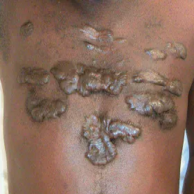 Trądzik keloidowy blizny keloidowe