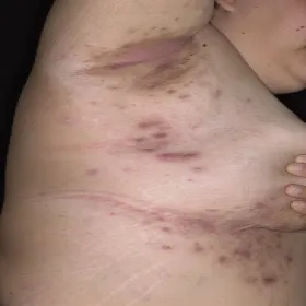 Trądzik odwrócony pod piersią