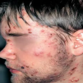 Trądzik piorunujący na twarzy