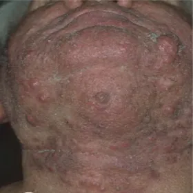 Trądzik skupiony na brodzie