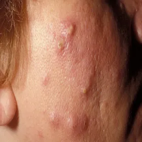 Trądzik skupiony wygląd