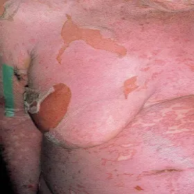 Uczulenie na leki przeciwbólowe 