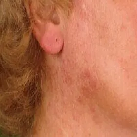 Uczulenie na słońce jak wygląda na twarzy