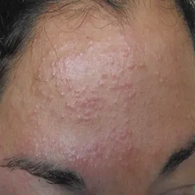 Uczulenie na słońce na czole