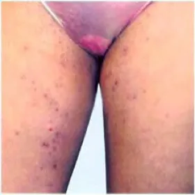 Uda zapalenie mieszków włosowych