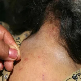 Ugryzienia wszy na ciele