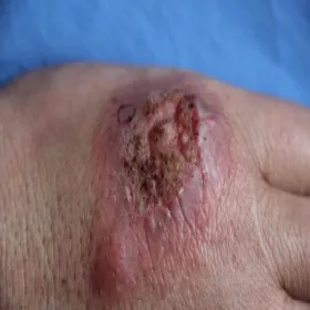 Ukłucie kolcem akacji choroba sporotrychoza 