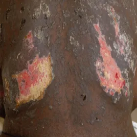 Uszkodzenie naskórka nekroliza 