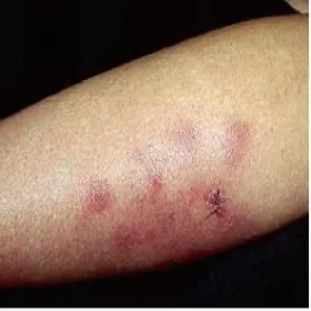 Uszkodzeniem podskórnej tkanki tłuszczowej