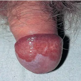 Vulvitis circumscripta plasmacellularis