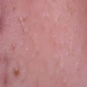 Wągry na skórze zdjęcie