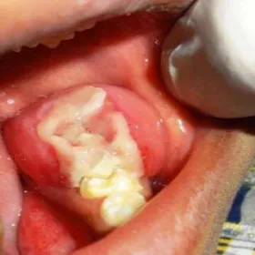 Włókniak jamy ustnej zdjęcia