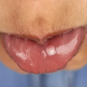 Włókniak na ustach