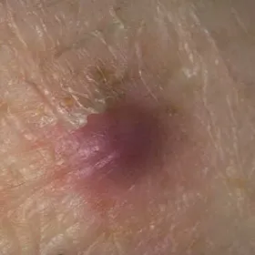 Włókniak skórny