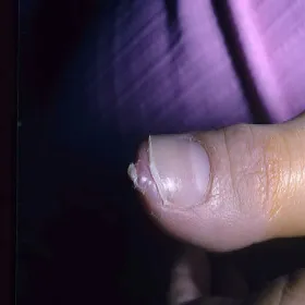 Włókniak twardy na palcu