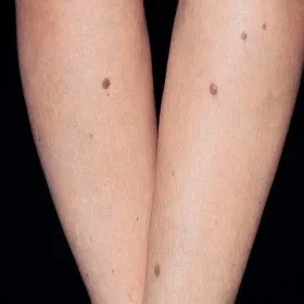 Włókniaki na rękach