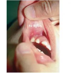 Warga wewnętrzna zmiana skórna 